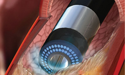 Interventionen bei komplexen peripheren L&auml;sionen