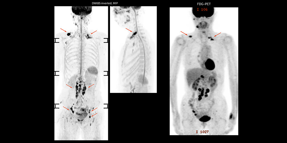 Diffusionsgewichtete Ganzk&ouml;rper-MRT