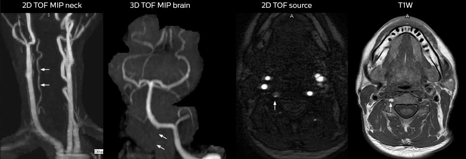 Magnetresonanzangiographie von Kopf und Hals