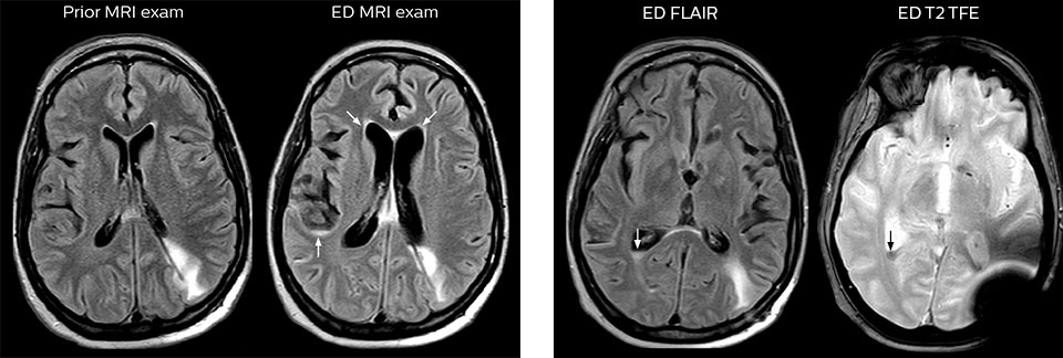 MRT zur Erkennung von Anzeichen f&uuml;r Meningeosis neoplastica