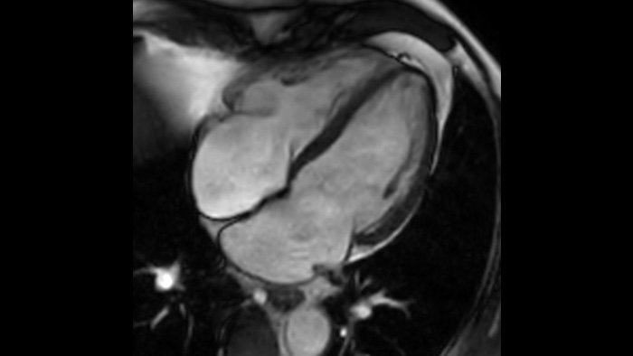 Bis zu 40% k&uuml;rzere Atemanhaltephasen