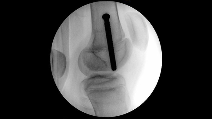 R&ouml;ntgenaufnahme eines Knochens mit einer Schraube darin