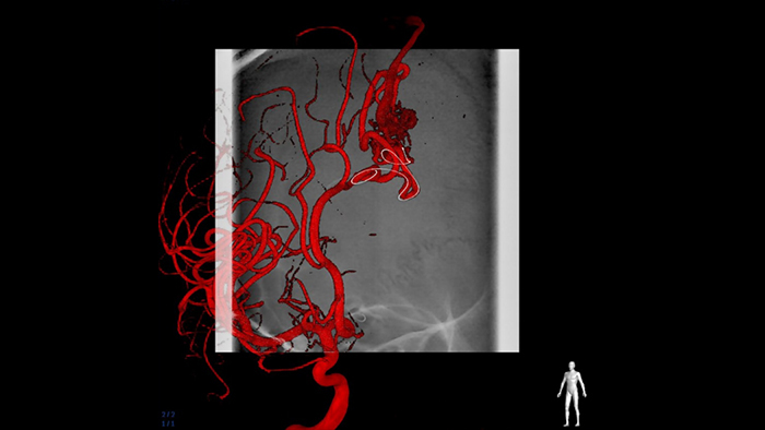 Navigation durch komplexe Gef&auml;&szlig;strukturen