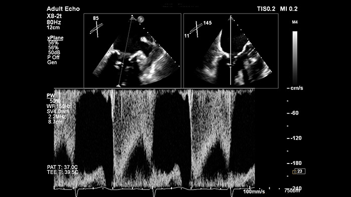 EPIQ&nbsp;CVx&nbsp;&ndash; xPlane Doppler