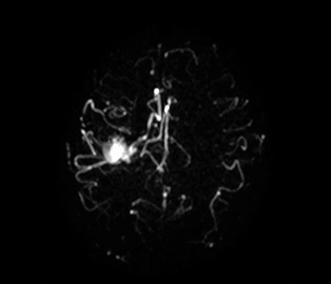 Kontrastmittelfreie Bildgebung der zerebralen Gef&auml;&szlig;anatomie​