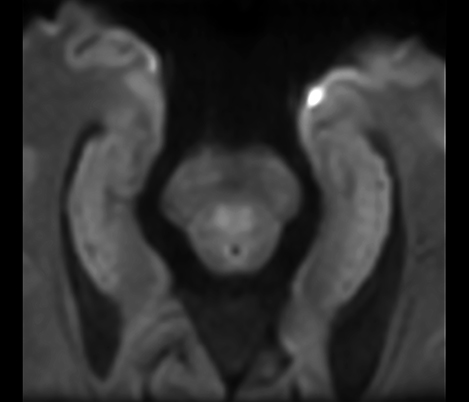 Diffusionsbildgebung mit kleinem FOV f&uuml;r eine bessere Bildqualit&auml;t​