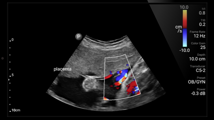Fr&uuml;he Beurteilung des fetalen Alters mit Lumify
