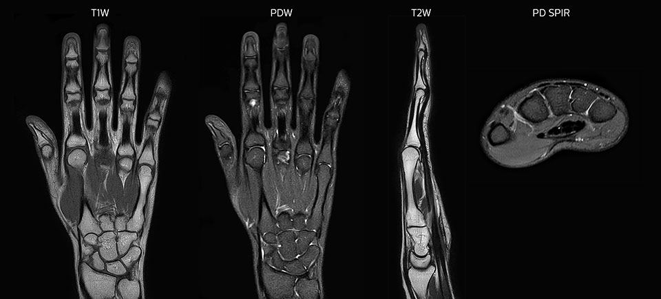 MRT Hand und Handgelenk mit gro&szlig;em FOV