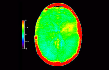 Hirnl&auml;sion image