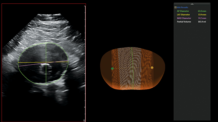 Ultraschall AAA Bild